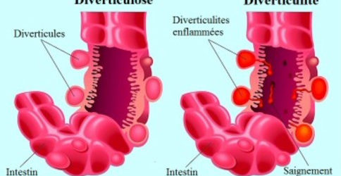 diverticulose