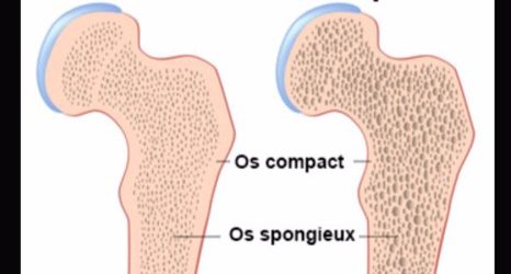 ostéoporose