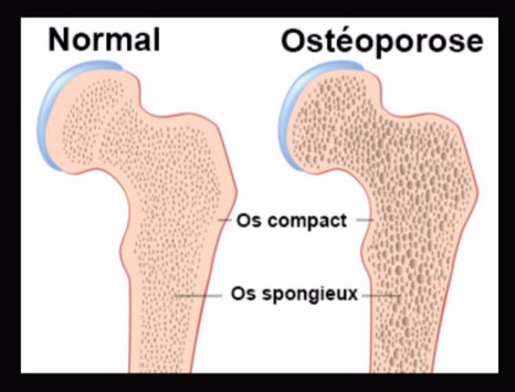ostéoporose