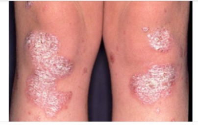 psoriasis