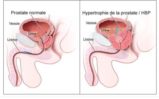 hypertrophie de la prostate